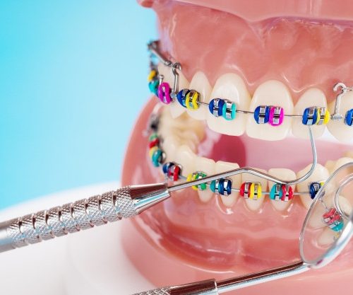 ۰ تا ۱۰۰ مراحل ارتودنسی دندان ها را بدانید
