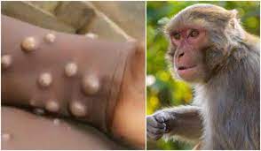 چه کنیم تا به ویروس آبله میمونی دچار نشویم؟+علائم بیماری آبله میمونی