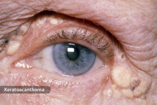 علت افتادگی پلک چشم چیست و چطور درمان می‌شود؟