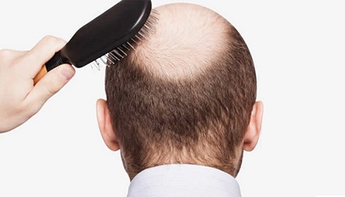 یک درمان خانگی ساده و فوری برای جلوگیری از ریزش موها