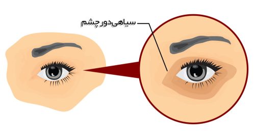 درمان سیاهی دور چشم 1