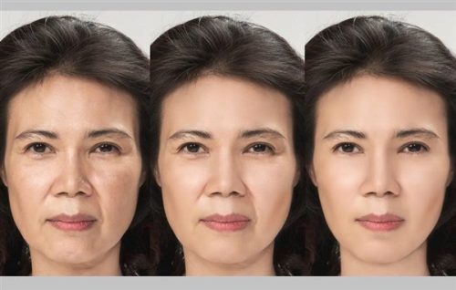 هایفوتراپی صورت ؛ روشی نوین برای جوانسازی و کشیدن پوست 8