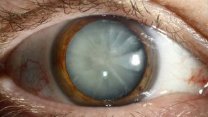 What is cataract 1