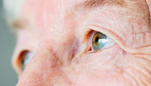 What is cataract 2
