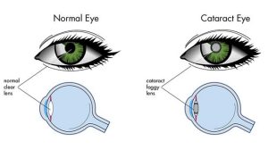 What is cataract 7