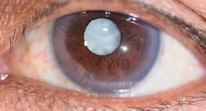 What is cataract 8