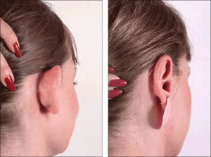 جراحی زیبایی گوش یا اتوپلاستی 5