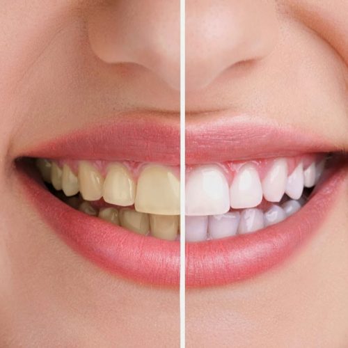 سه روش طبیعی و خانگی برای سفید کردن دندانها